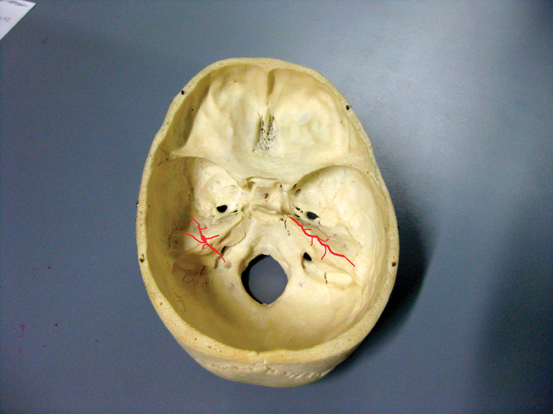 Fractures perpendiculaire et longitudinale de l’os pétreux. fig3